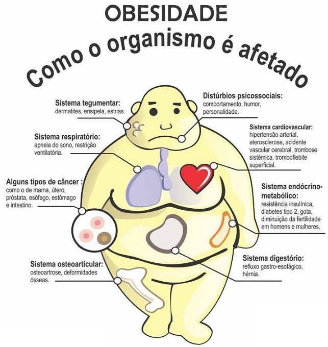 Resultado de imagem para obesidade